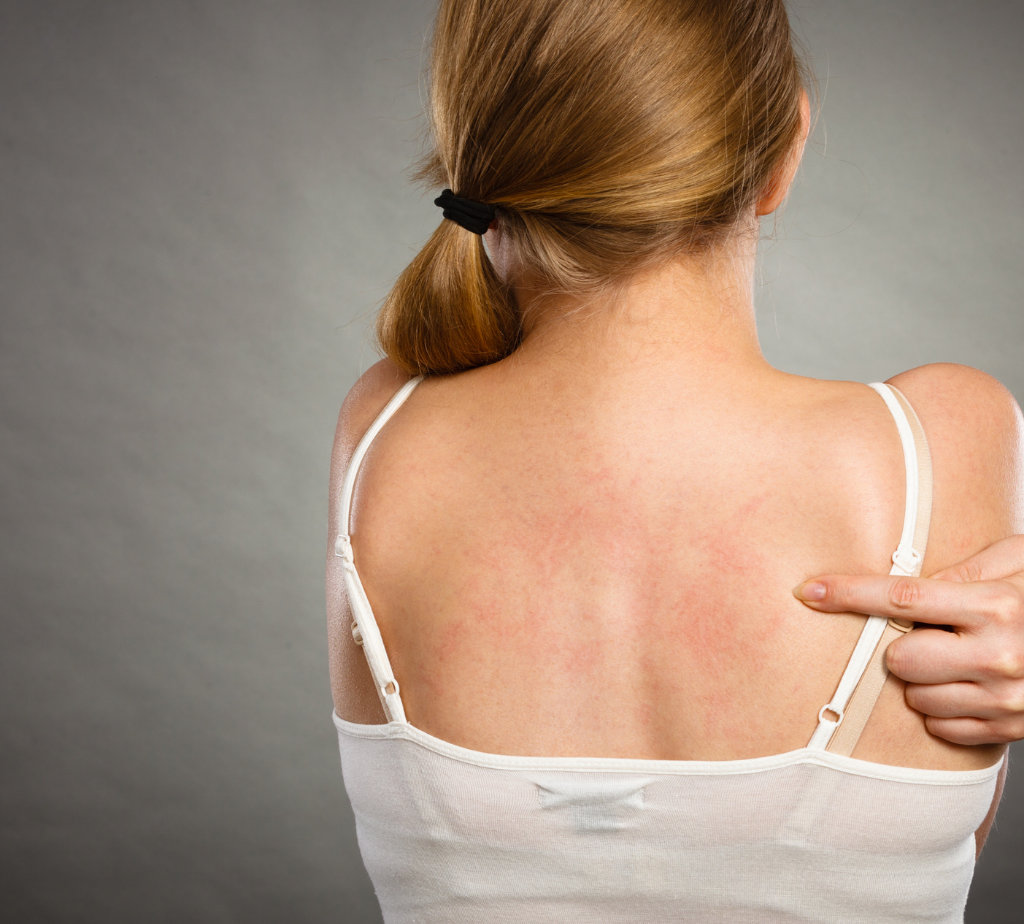 sintomi della dermatite atopica