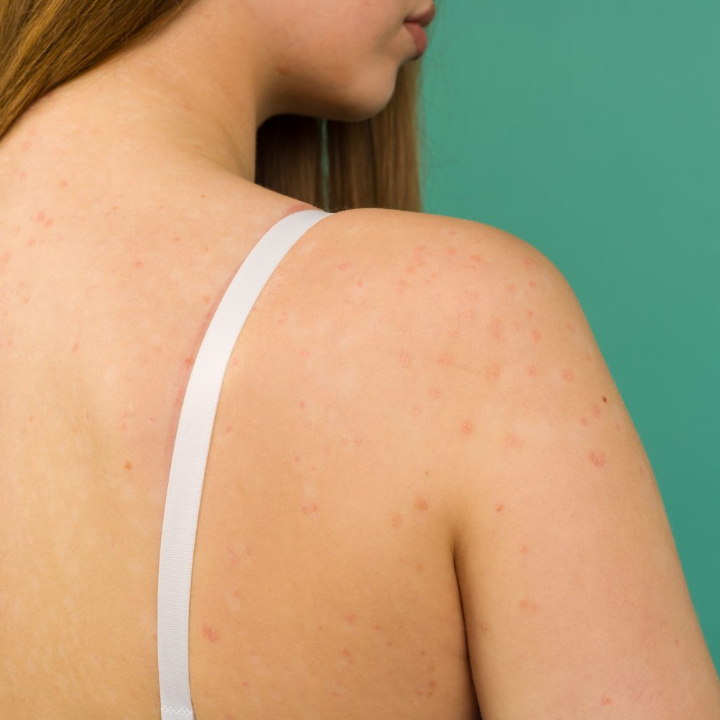 sintomi della dermatite atopica